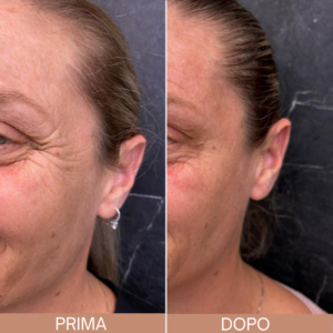 Botox Palermo
