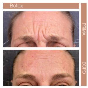 Botox Incandela
