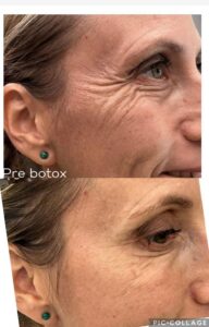 Cinzia Incandela botox