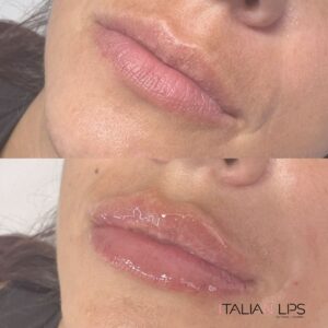Filler labbra ItalianLIPS